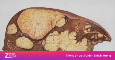 Bác sĩ cảnh báo 'thuốc bổ gan' không giúp giải độc sau nhậu