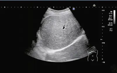 Nam sinh 15 tuổi nhập viện vì gan nhiễm mỡ nặng do uống trà sữa thường xuyên
