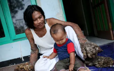 Người cây Indonesia: Từ vết xước đầu gối đến bi kịch cuộc đời