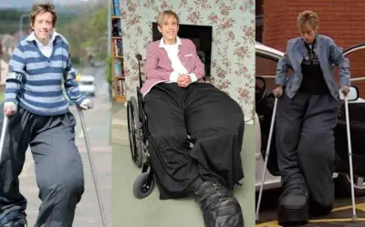 Người phụ nữ sở hữu đôi chân khổng lồ nặng gần 100kg: Hành trình vượt lên số phận