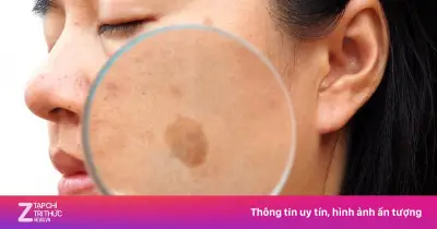 Vì sao phụ nữ dễ bị nám da khi mang thai? Nguyên nhân và giải pháp