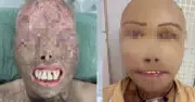 16 giờ phẫu thuật tái tạo khuôn mặt cho bệnh nhân bỏng nặng