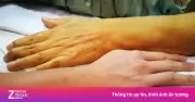 6 dấu hiệu cảnh báo gan tổn thương, cần đi khám sớm