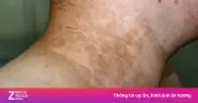 7 dấu hiệu bệnh tiểu đường biểu hiện trên mặt và cổ