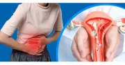 7 dấu hiệu thường gặp của lạc nội mạc tử cung chị em nên chú ý