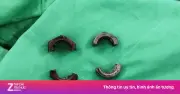 Đai ốc siết chặt 'cậu nhỏ' suốt tháng, người đàn ông 38 tuổi nhập viện cấp cứu
