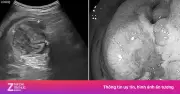 Đau bụng 3 tháng không khỏi, người đàn ông 70 tuổi phát hiện ung thư đại trực tràng