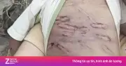 Bé 2 tuổi ở TP.HCM bị mẹ và người tình bạo hành dã man, đa chấn thương nặng