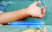 Bé 7 tuổi suýt mất bàn tay vì máy tự chế: Hồi chuông cảnh báo trong nhiều gia đình