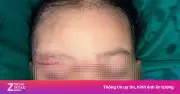 Bé gái 22 tháng tuổi bị chó cắn nặng vùng mặt nhập viện cấp cứu