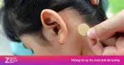 Bé gái 7 tuổi loạn thần vì miếng dán chống say xe chứa scopolamine