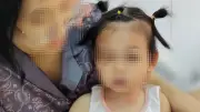 Bé gái bị chó cắn nát mặt nhập viện trong tình trạng hoảng loạn