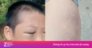 Bé trai 11 tuổi nghi bị bố và mẹ kế bạo hành ở Nghệ An, công an vào cuộc