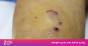 Bé trai 14 tuổi hôn mê vì bệnh dại sau 6 tháng bị chó nhà cắn