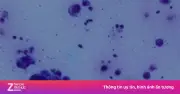Bé trai 4 tuổi khỏe mạnh bất ngờ mắc cùng lúc zona thần kinh và thủy đậu