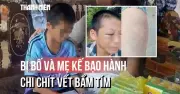 Bé trai nghi bị bố và mẹ kế bạo hành nhập viện với chi chít vết bầm tím
