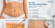 Bác sĩ cảnh báo rủi ro khi hút mỡ tạo hình bụng không đúng quy trình