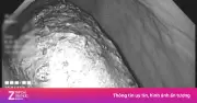 Bác sĩ kinh ngạc lấy khối bã thức ăn khủng trong dạ dày bệnh nhân