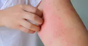 Bệnh giun đũa chó mèo: Nguy cơ tiềm ẩn từ môi trường sống