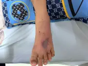 Bệnh nhi 11 tuổi ở Cà Mau ngưng thở vì rắn cắn, bác sĩ cứu sống kịp thời