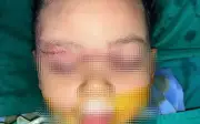 Bệnh nhi 22 tháng tuổi bị chó cắn tổn thương vùng mặt được cứu sống