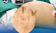 Bệnh nhân trẻ mang khối u buồng trứng 30cm, thoát cảnh mất buồng trứng