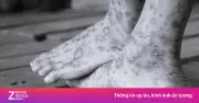 Bệnh viêm da lạ bùng phát tại Quảng Ngãi: Nguyên nhân và cách phòng tránh