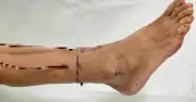Bệnh viện Trường ĐH Y Dược Huế nối thành công bàn chân đứt lìa cho bệnh nhân