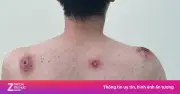 Báo động đỏ: Bệnh lây qua tình dục trẻ hóa tại TP.HCM, 53% ca bệnh là thanh niên