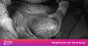 Bất ngờ với khối u ruột non nặng 3 kg ở người đàn ông 43 tuổi