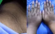 Cô gái 20 tuổi nhập viện vì biến chứng đái tháo đường chỉ từ dấu hiệu tưởng đã bán