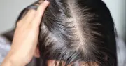 Chế độ ăn uống ảnh hưởng thế nào đến rụng tóc? Bí quyết giảm rụng tóc hiệu quả