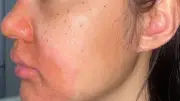 Cảnh báo nguy hiểm từ peel da tại spa không uy tín