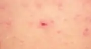 Cảnh báo virus Hanta trên tàu du lịch, Bộ Y tế khuyến cáo phòng bệnh