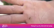 Dồn dập 3 ca tiêm phòng dại nhập viện trong 30 phút giữa nắng nóng