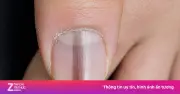 Dấu hiệu bất thường ở móng tay cảnh báo tiểu đường, gan nhiễm mỡ