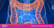Dấu hiệu cảnh báo ung thư đại trực tràng dễ bị nhầm với bệnh trĩ
