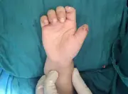 Hà Nội: Bé trai 5 tuổi đứt rời 2 ngón tay khi chơi xe điện tự chế