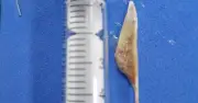 Hóc xương dài hơn 3,5 cm, bệnh nhân 74 tuổi suýt nguy kịch