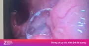 Hy hữu: Người đàn ông nhập viện vì hóc lông lợn trong bánh mì pate