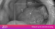 Đi ngoài ra máu suốt một năm, người đàn ông phát hiện polyp khổng lồ hình cây nấm