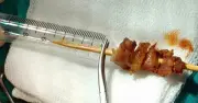 Kích hoạt toàn bệnh viện cứu bé gái bị que xiên thịt đâm suýt xuyên sọ