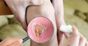 Kiểm soát chủ động vết thương: Chìa khóa vàng cho lành thương nhanh và thẩm mỹ