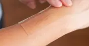 Miếng dán silicone điều trị sẹo lồi: Giải pháp an toàn và hiệu quả