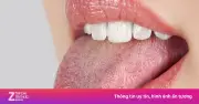 Mảng trắng lan rộng, đau rát miệng lưỡi: Dấu hiệu nhiễm nấm Candida