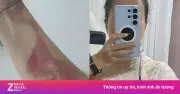 Nổ nồi xông hơi khi gội đầu dưỡng sinh, khách nữ bỏng độ 2