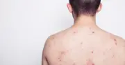 Nam thanh niên 23 tuổi nhiễm HIV và giang mai sau chuyến du lịch Thái Lan
