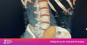 Nam thanh niên nhập viện vì 'trứng rồng' mắc kẹt ở trực tràng