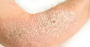 Người bệnh vảy nến khổ sở vì bị kỳ thị, không dám bắt tay