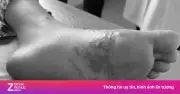 Người đàn ông 60 tuổi nhiễm 5 loại ký sinh trùng vì thói quen ăn uống